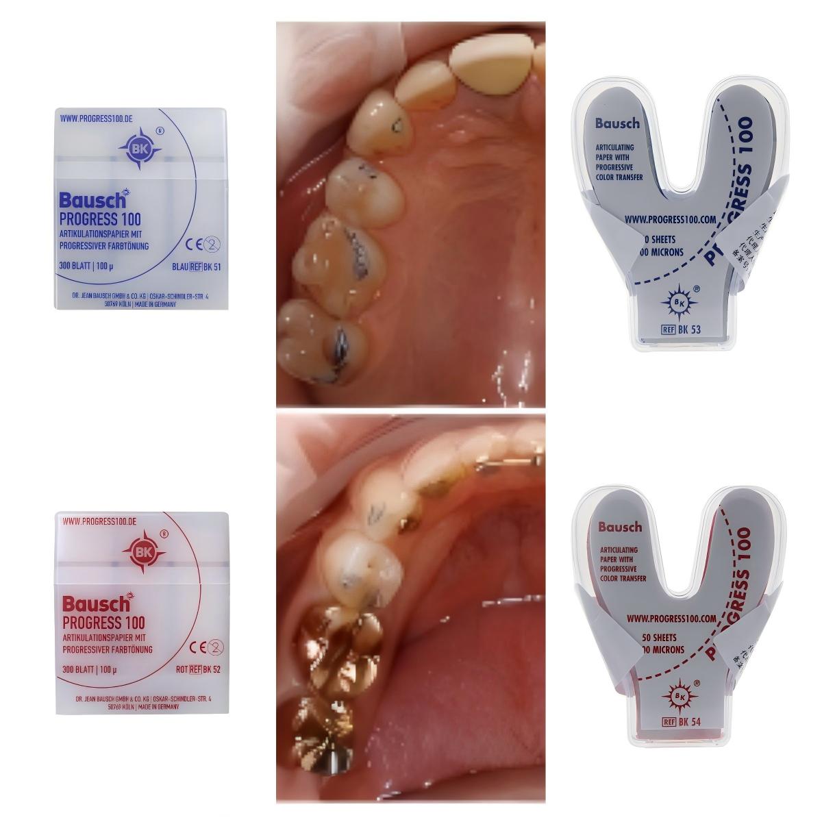 Bausch BK51 BK52 BK53 BK54 Tan - Bite Indicator recensie en prijs